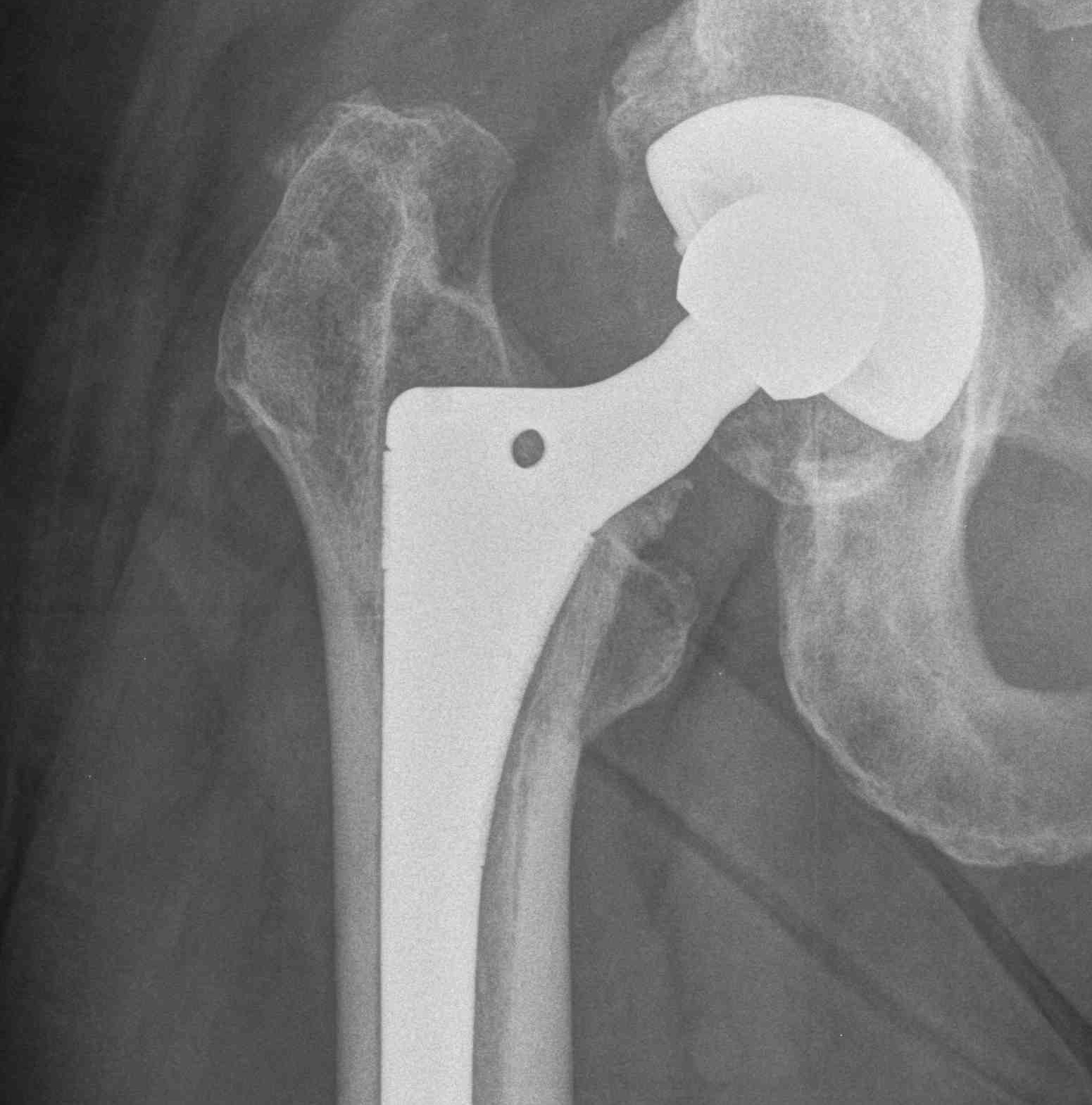 THR Subsidence Uncemented Component